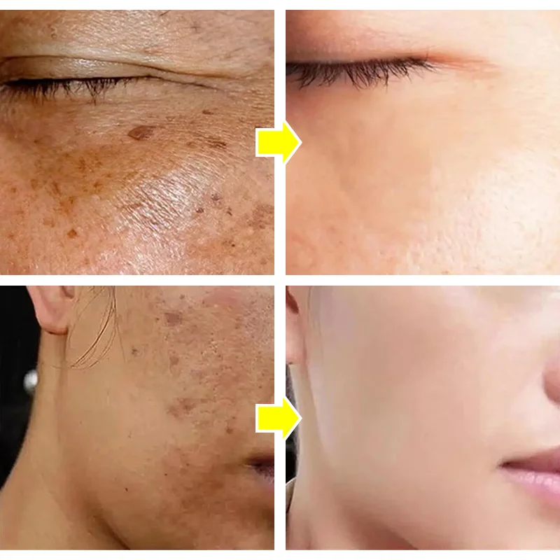 Potente crema sbiancante per la rimozione delle macchie Illumina la pelle Elimina rapidamente la pigmentazione della melanina Melasma Macchie scure Cura della pelle coreana