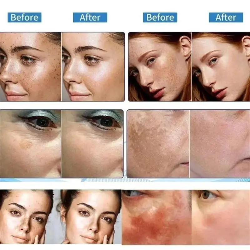 Potente crema sbiancante per la rimozione delle macchie Illumina la pelle Elimina rapidamente la pigmentazione della melanina Melasma Macchie scure Cura della pelle coreana